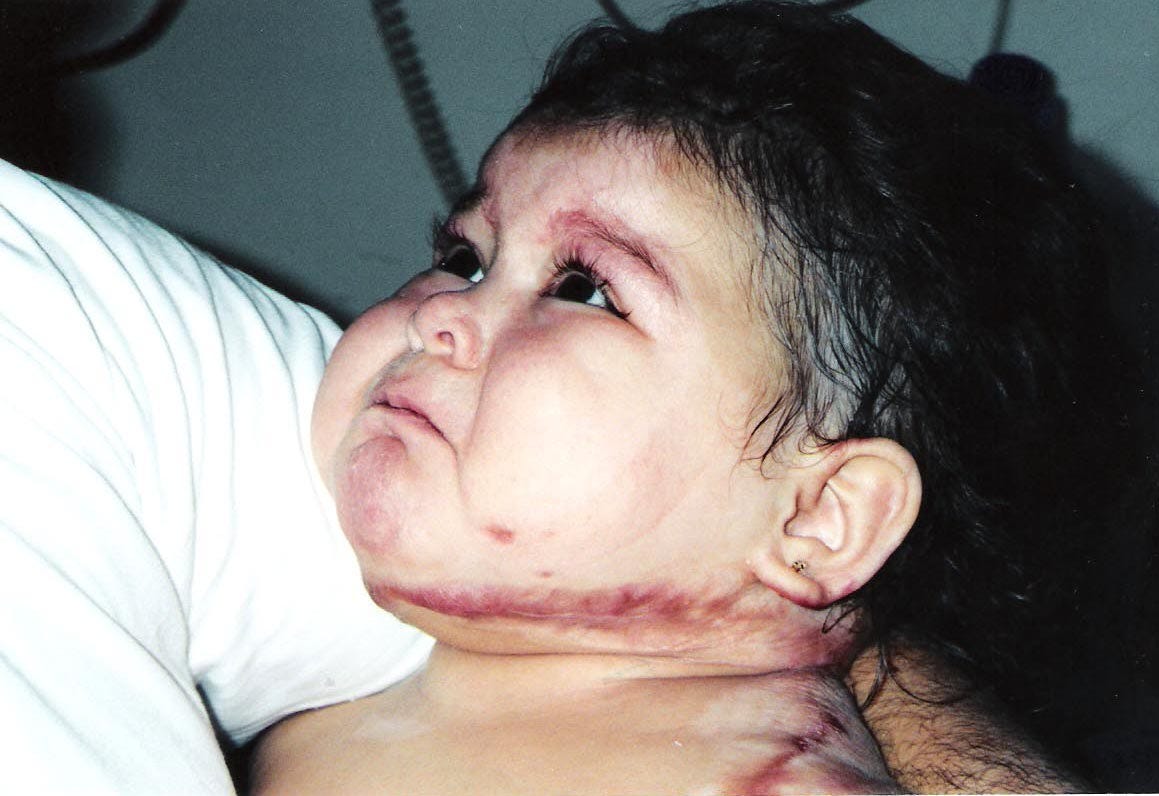Karizma Vargas suffered severe brain damage after an accident when she was 14 months old.