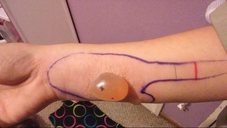 Spiders-Bite-Diagnosis-Allopathic and Homeopathic-Treatment | Homeopathic | Best Homeopathic Doctor in Pakistan | Dr Qaisar Ahmed MD, DHMS