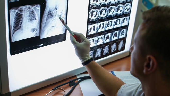 De National Lung Screening Trial van 2011 toonde een vermindering van 20% in longkankersterfte bij hoogrisicopatiënten die een lage dosis CT-scans kregen in vergelijking met thoraxfoto's.