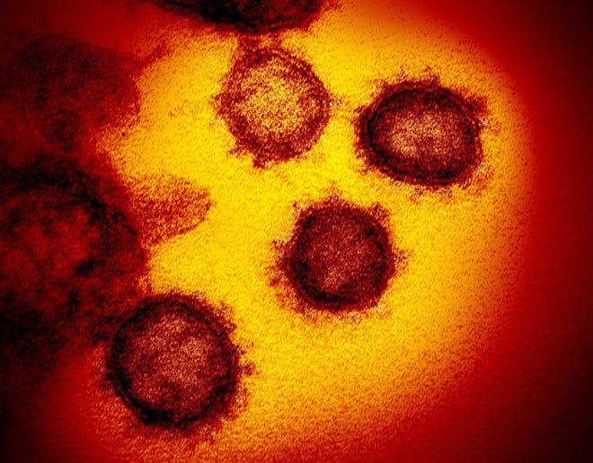 This undated electron microscope image made available by the U.S. National Institutes of Health in February 2020 shows the Novel Coronavirus SARS-CoV-2. Also known as 2019-nCoV, the virus causes COVID-19. The sample was isolated from a patient in the U.S.