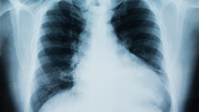 Certain medications increase lung complications.