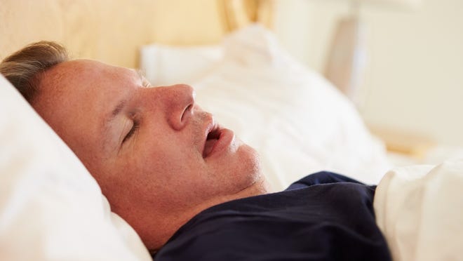 Sleep apnea is a condition in which breathing stops periodically during sleep.