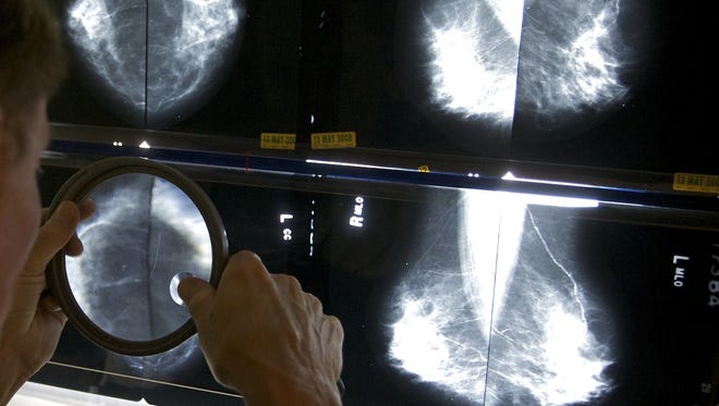 More young women are being diagnosed with advanced breast cancer, according to a new study.