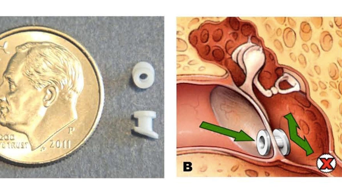 Guide Not All Kids Need Ear Tubes To Relieve Fluid