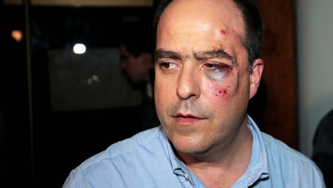 Opposition lawmaker Julio Borges arrives with a bruised face to his political party's headquarters before speaking to the press in Caracas, Venezuela, April 30, 2013.