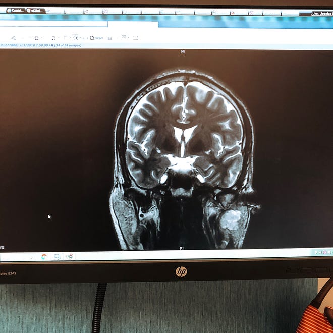 Ray High School graduate Clint Gresham posted this picture of a head scan on his Instagram post announcing that doctors had found a tumor in his head.