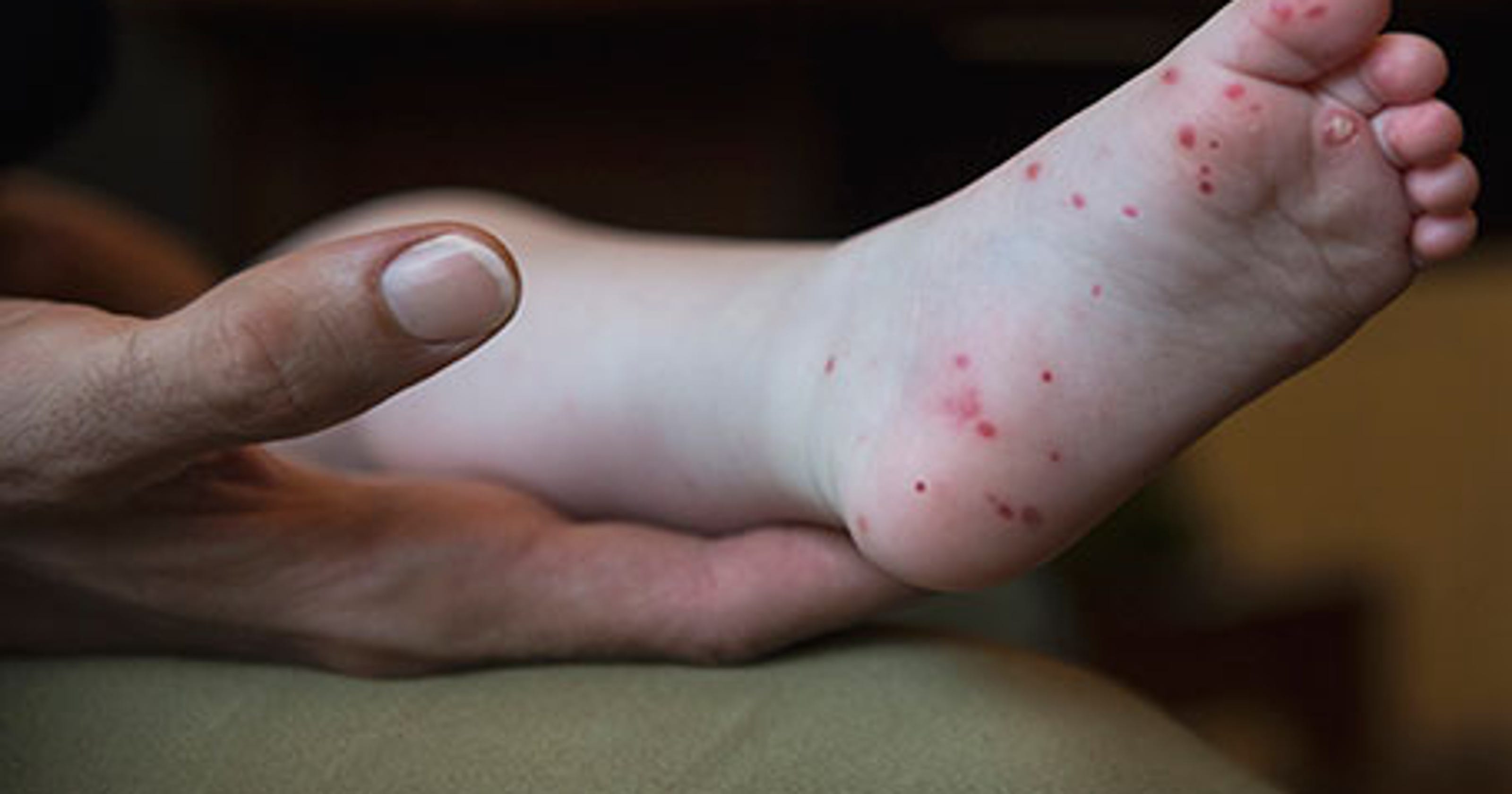 hand-foot-and-mouth-disease-in-east-tennessee-fewer-cases-in-2018