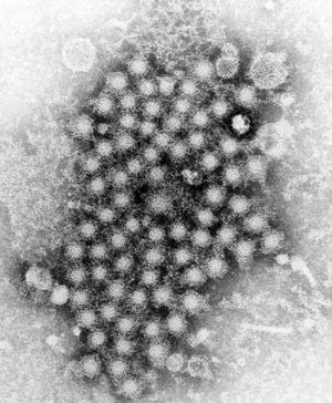 This electron micrograph shows numerous hepatitis virions, strain unknown, which are the agents for viral hepatitis. The CDC describes viral hepatitis as an important public health problem because it causes serious illness, it affects millions, and it has a close connection with HIV. There are five identified types of viral hepatitis and each one is caused by a different virus. In the United States, hepatitis A, hepatitis B and hepatitis C are the most common types.