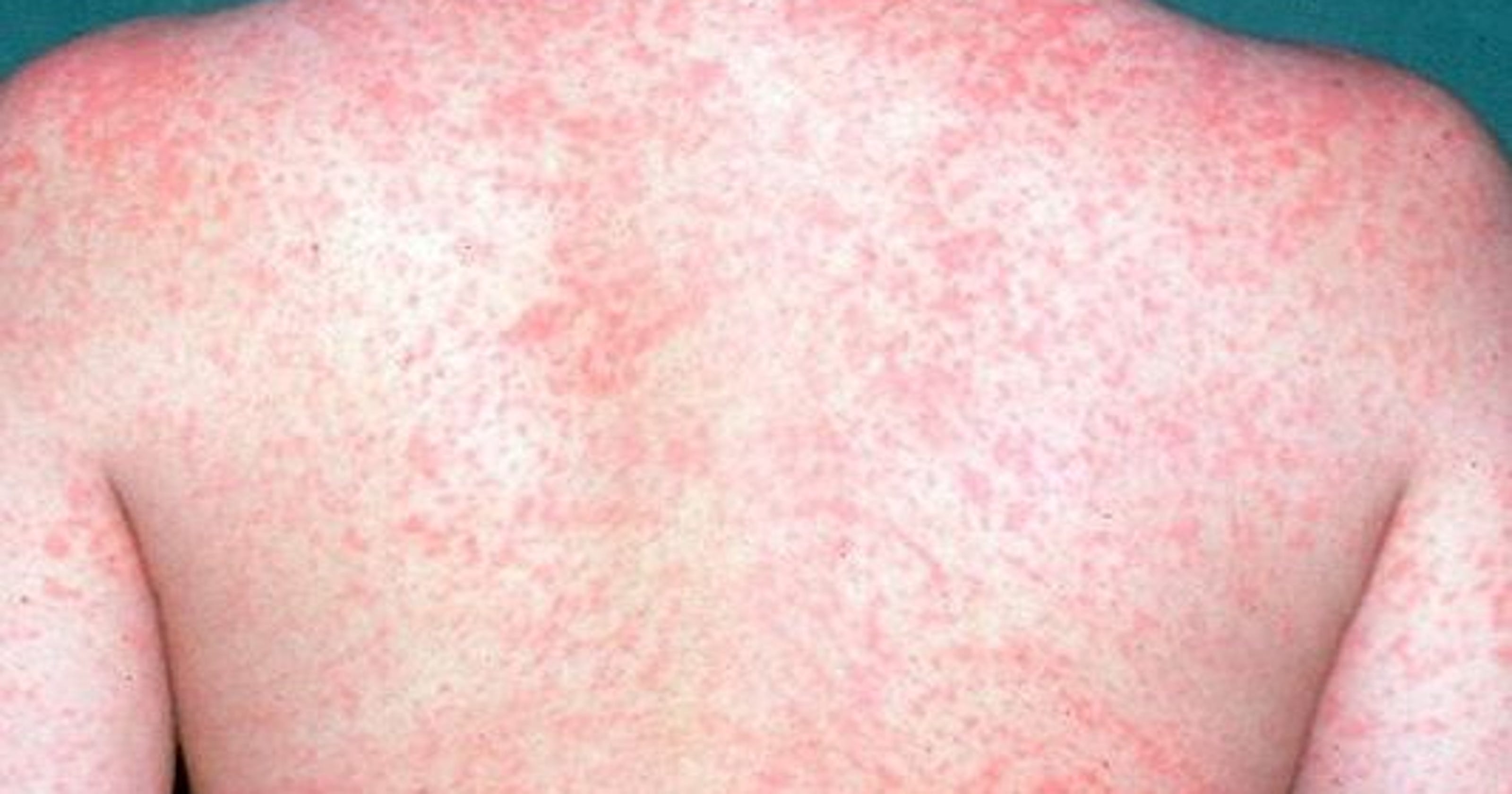 Measles outbreak VT cases rare, but low immunization rates concerning