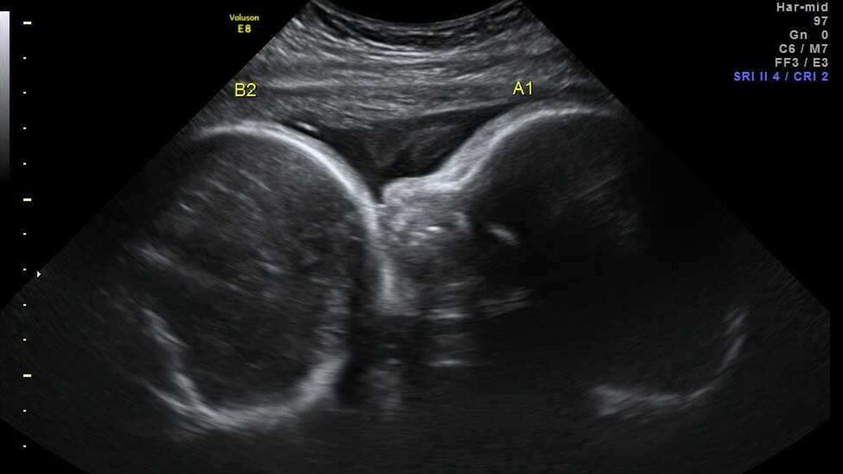 An ultrasound photo of Elijah and Abigail Zuniga in January 2018.