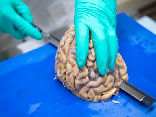 Ann C. McKee slices the brain into segments about a quarter-inch thick as part of in-depth, time consuming research on the organ. McKee hopes the work will unlock answers to CTE.