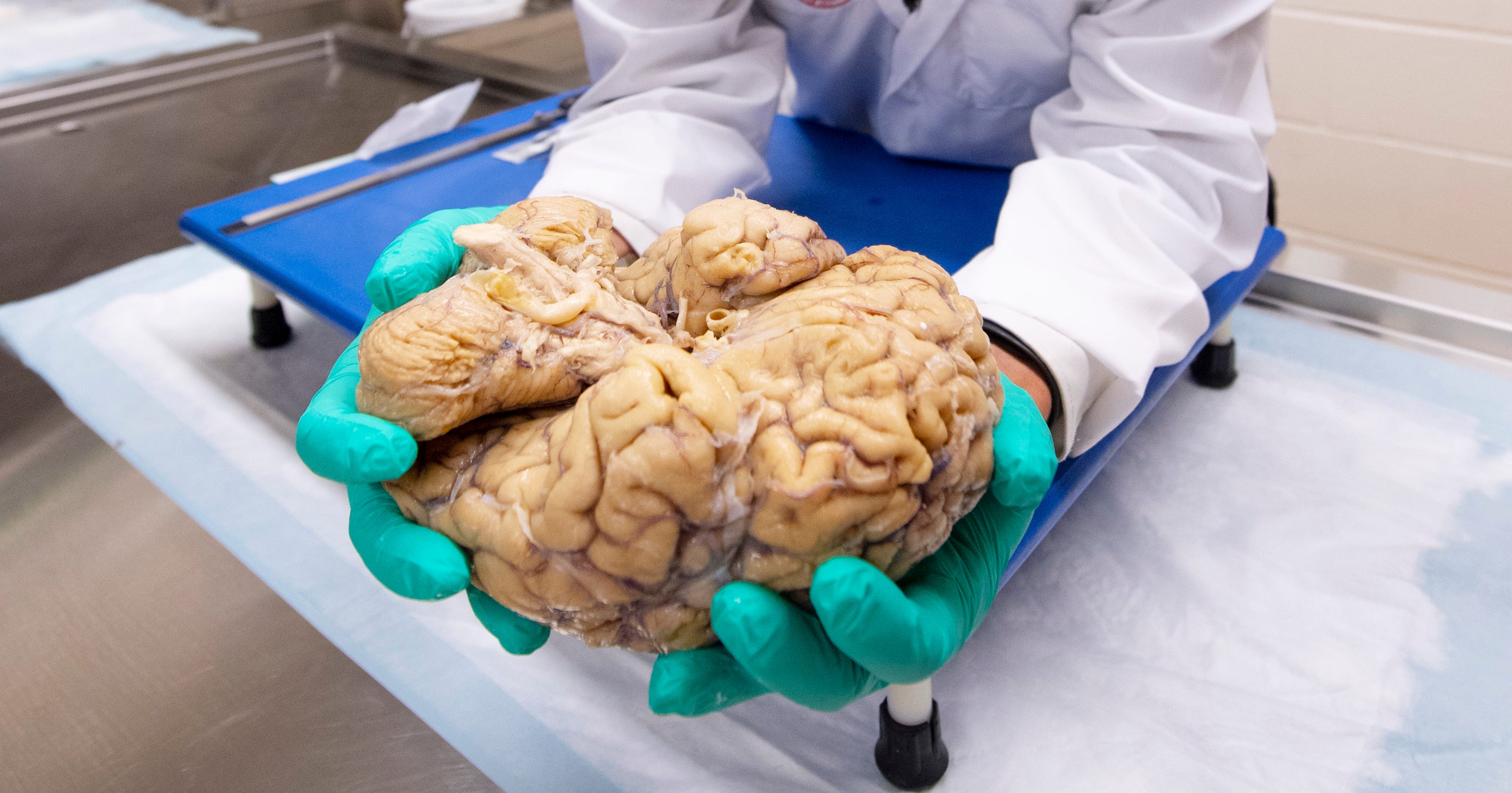 CTE: Unlocking a diagnosis to neurodegenerative brain disease