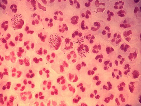 Xxx Gonorrhea Jpg D Fea