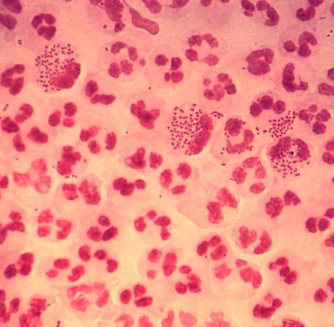 This is an image of gonorrhea.