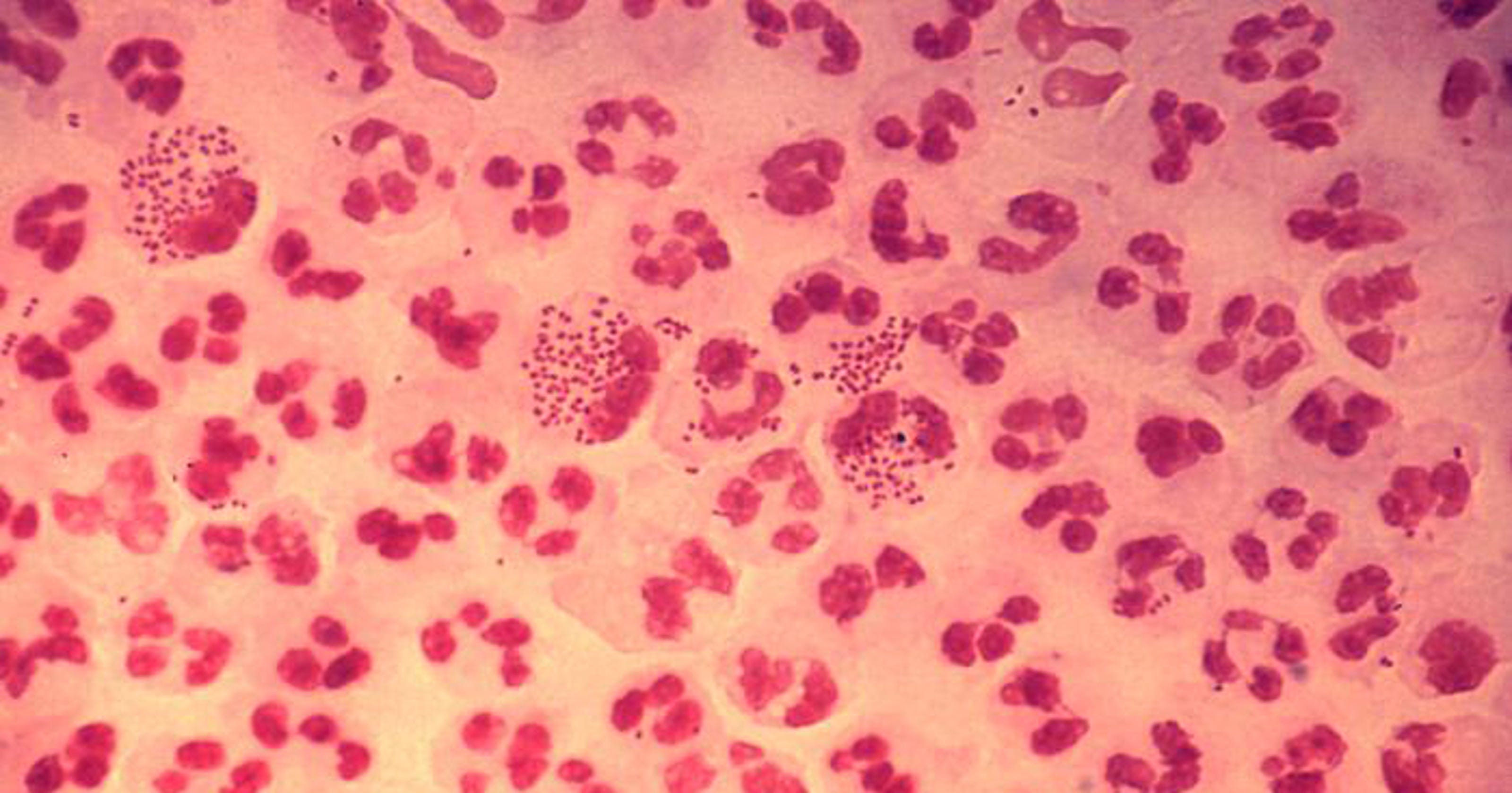 Cdc reports a surge in gonorrhea other sexually transmitted diseases