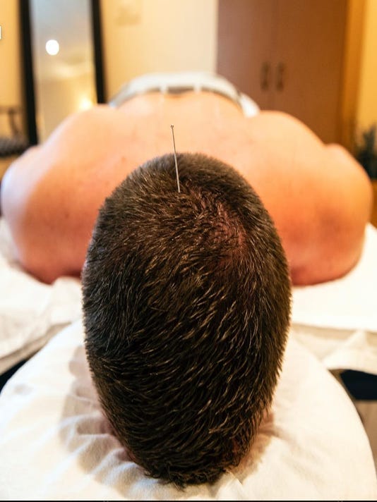 I put a needle in my head to help my back pain