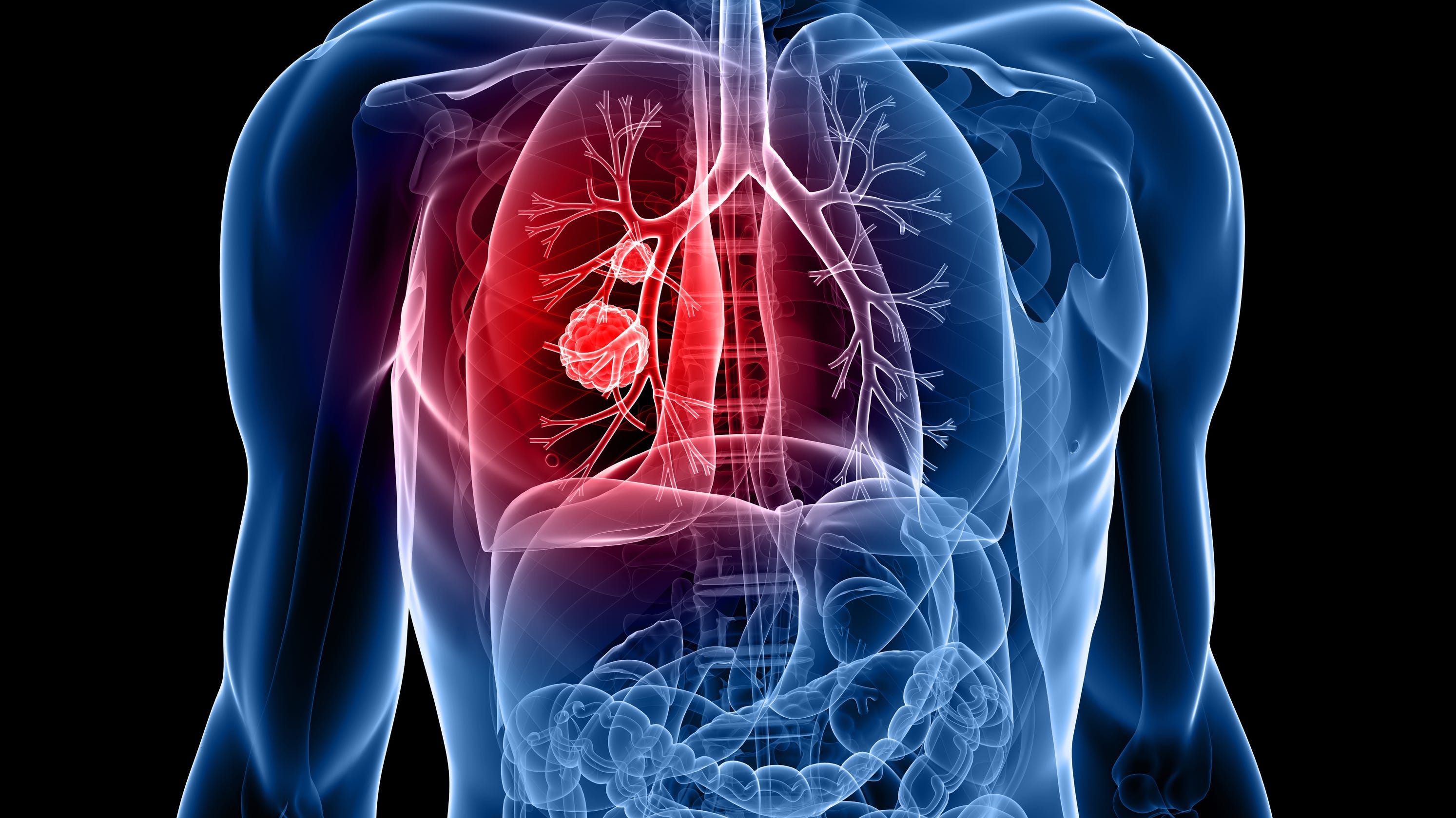 Early Screening For Lung Cancer May Save Or Extend Your Life early-screening-for-lung-cancer-may-save-or-extend-your-life
