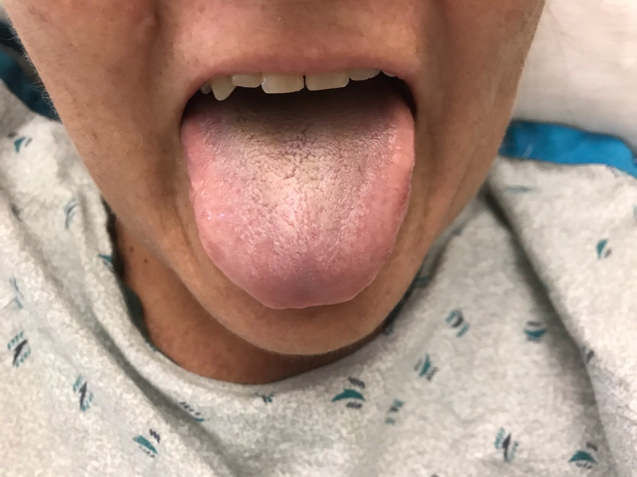 Black hairy tongue: What is it, and how do you get it