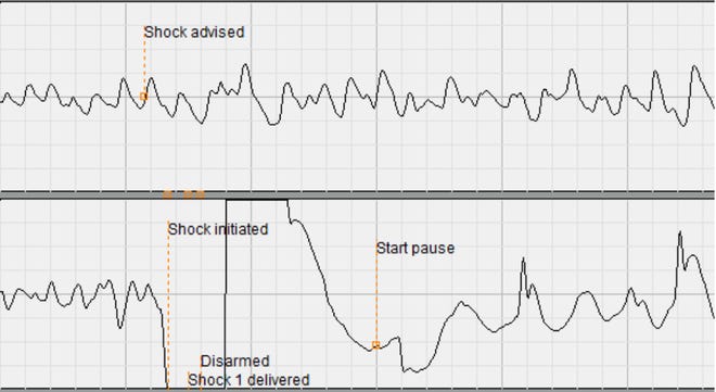 A chart from the automated external defibrillator used to restart the heart of a 52-year-old Wauwatosa man, shows in the upper graphic how his heart was not beating efficiently. The lower chart shows a determined heartbeat after a shock was administered.