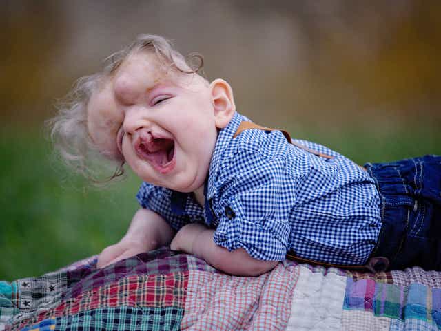 Baby Born With No Skull Continues To Amaze Family Doctors