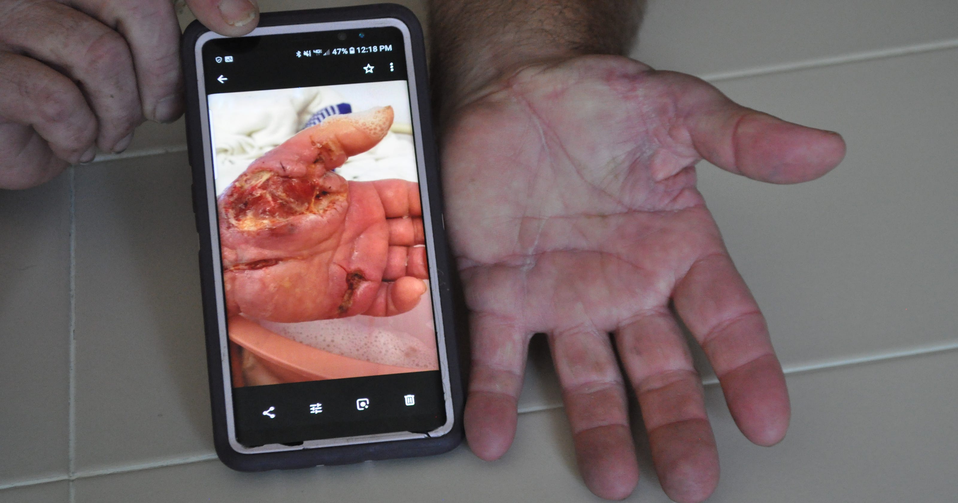 Vibrio vulnificus Meet the man who beat the "flesheating" bacteria