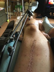 With his leg immobilized during his recovery, Randy Seals was bed-bound for months after accidentally shooting himself while hunting.