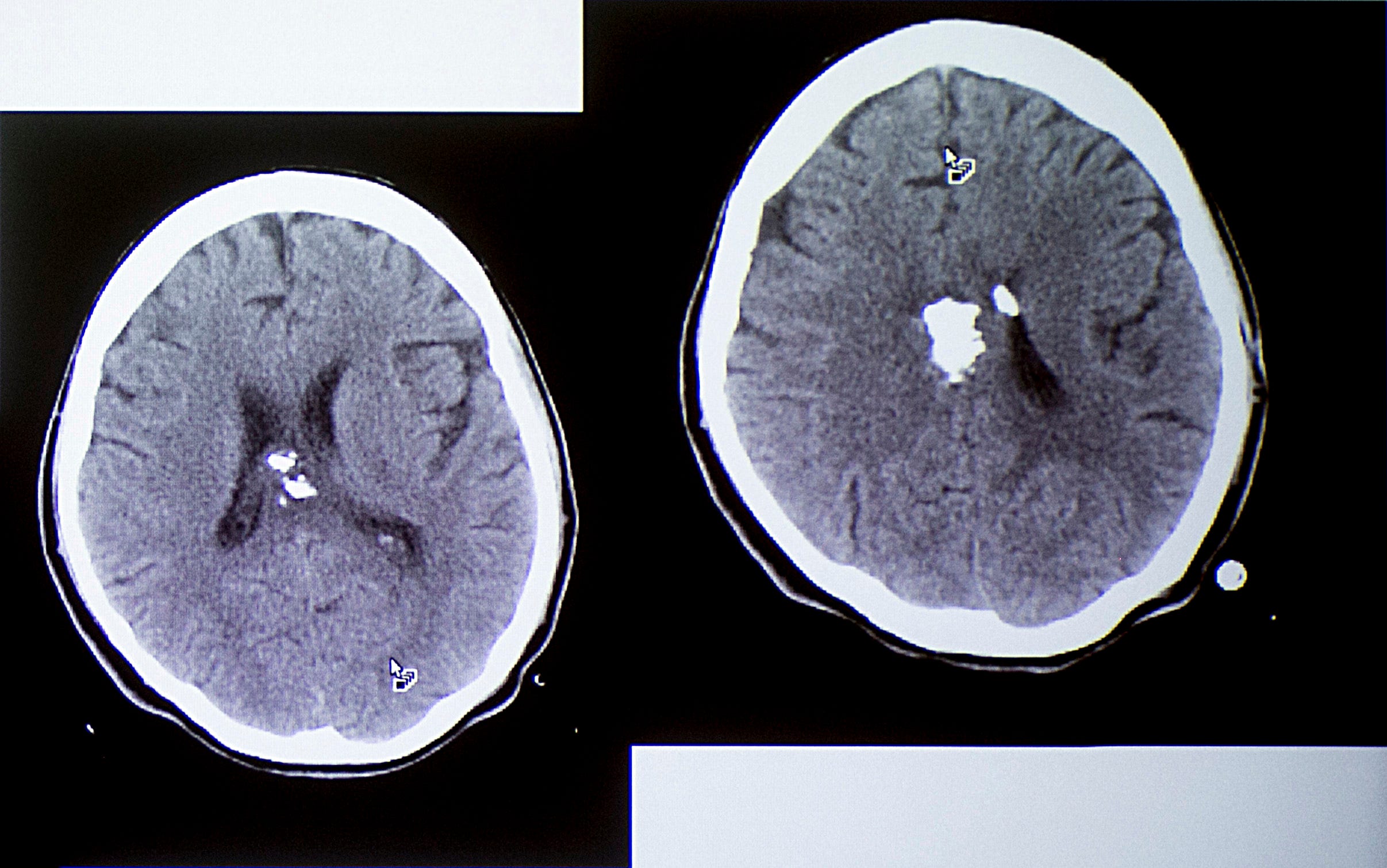 Bullet fragments, which appear white, show up on a brain image of Jovanna Calzadillas.