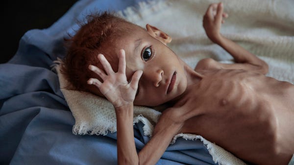 A severely malnourished boy rests on a hospital...