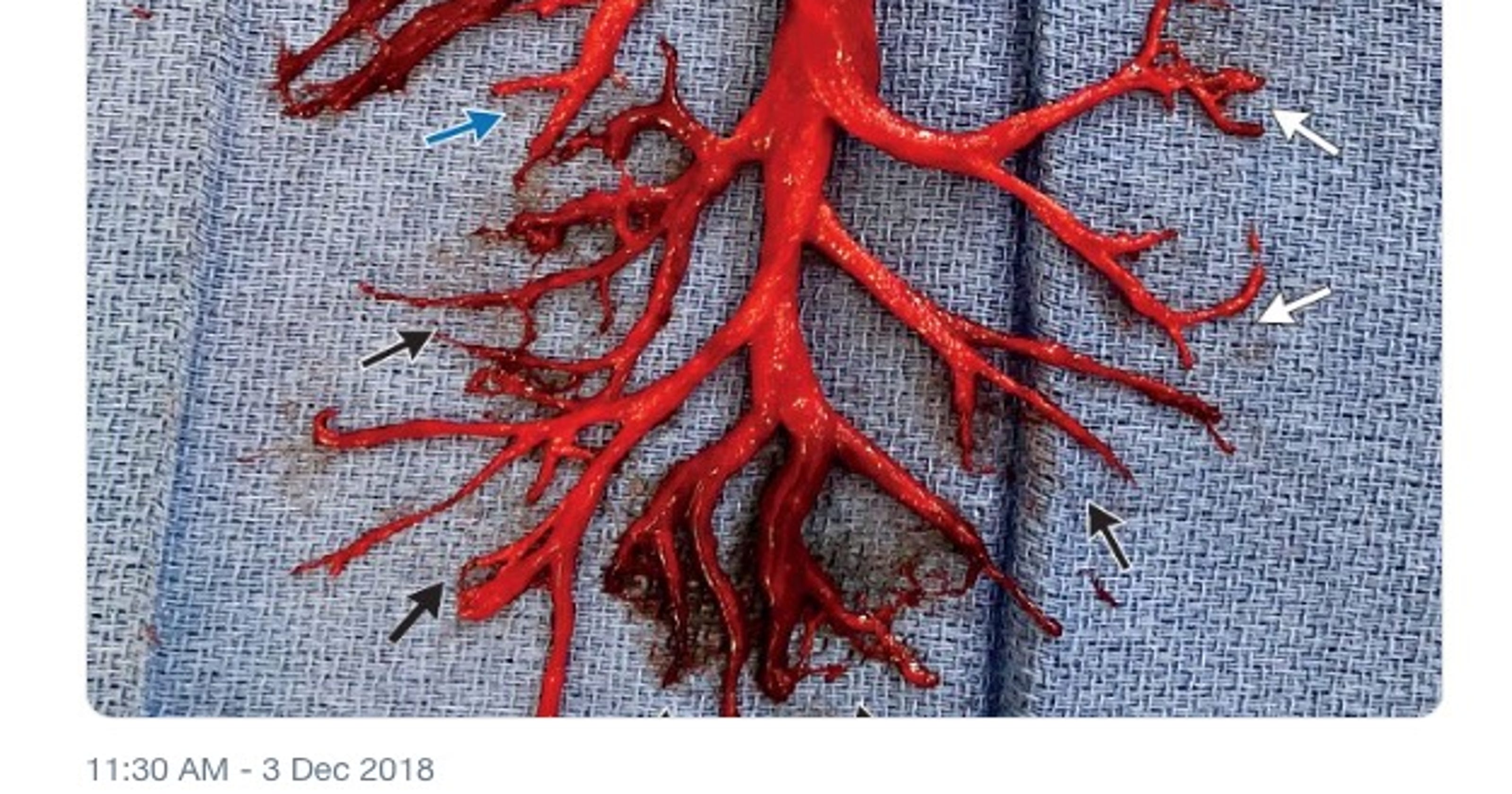 NEJM shares odd photo of blood clot shaped like lung. A man spit it up