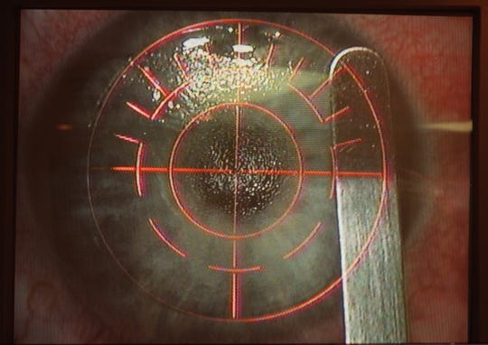 A close-up view of a Lasik eye surgery