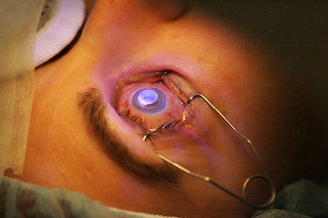 Ultraviolet fluorescence (the blue light) is seen on the corneal tissue as it is vaporized (removed) by the laser as it reshapes the contour of the cornea based on predetermined measurements during Lasik eye surgery performed in 2008.