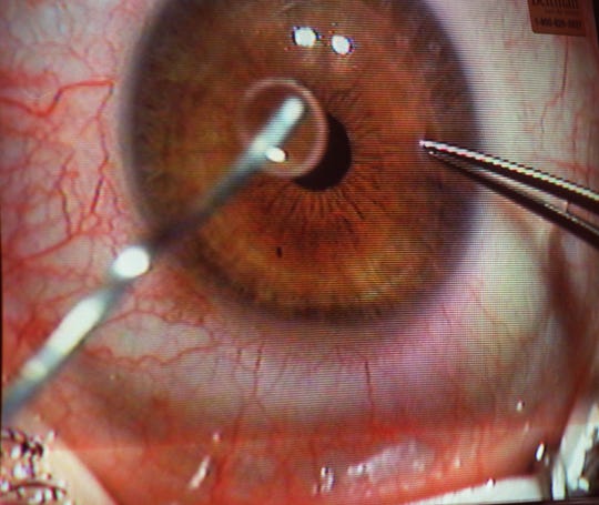 Close-up view of a Lasik eye surgery