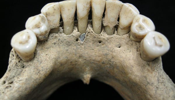 The lower jaw of a medieval skeleton reveals...