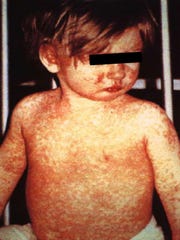 In this picture, a young child is presented with a classic measles rash after four days.