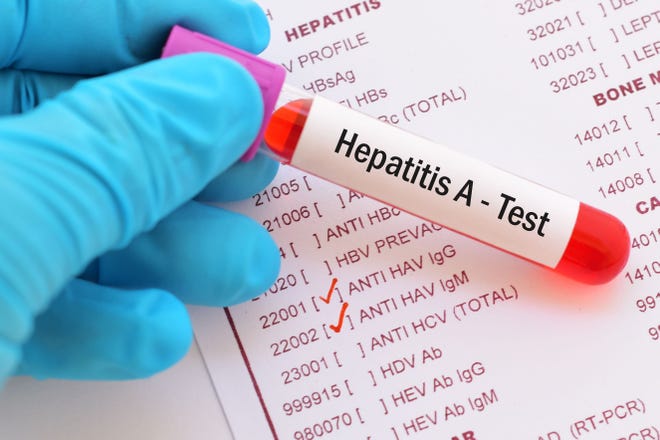 Blood sample for hepatitis A virus (HAV) test