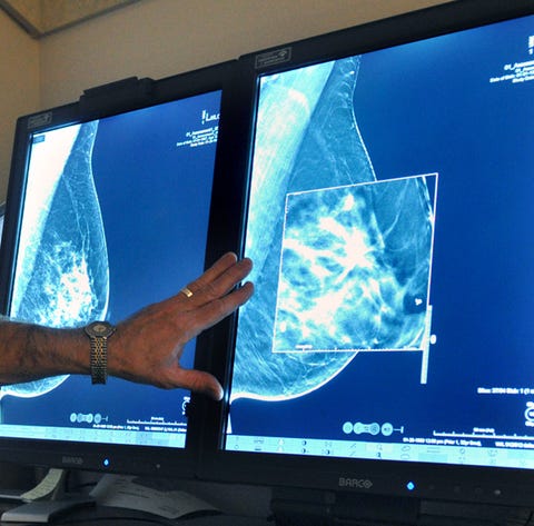 Dense breast tissue can hide cancer and tumors. A...