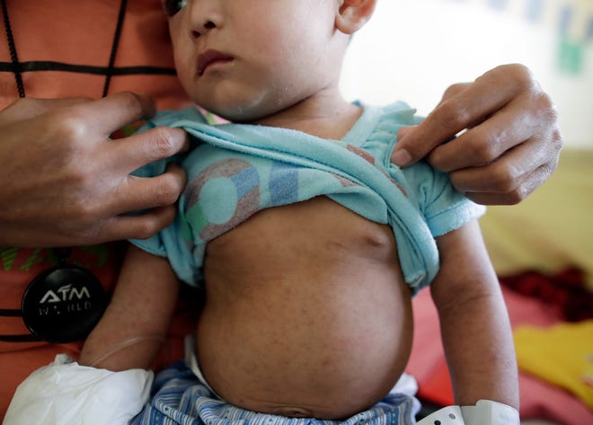 A rash is seen all over the body of a child suffering from measles.