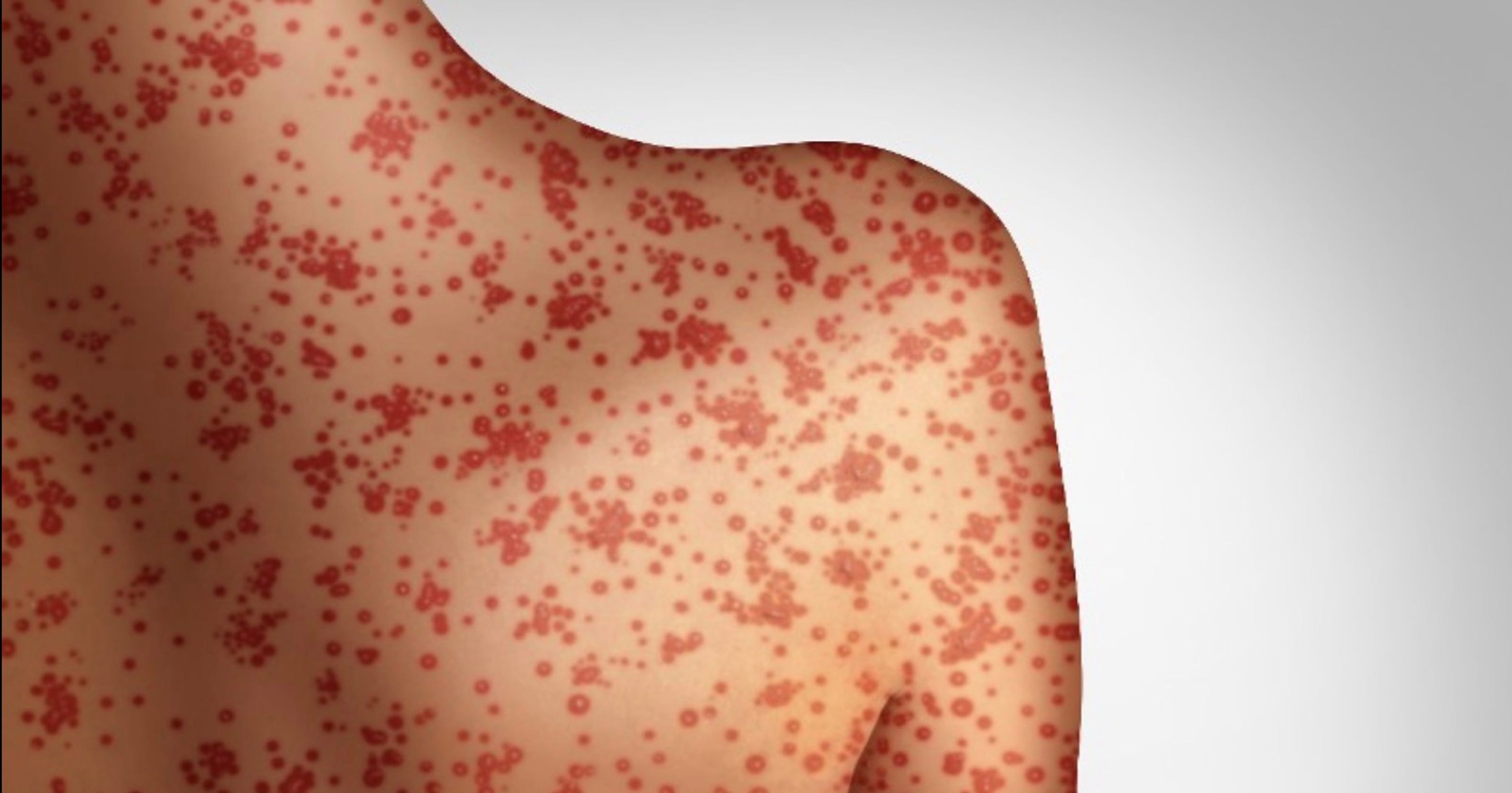 measles symptoms