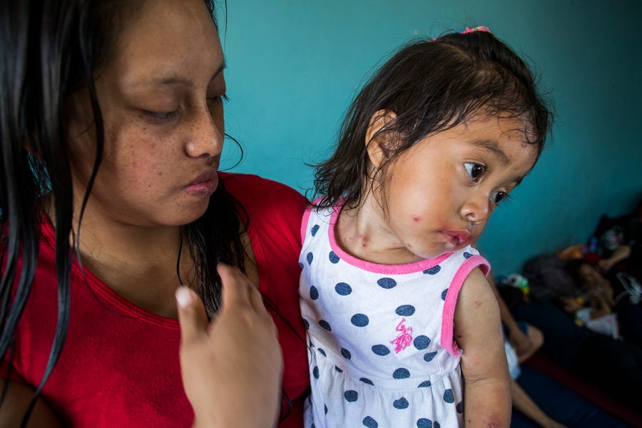Mirsa Garcia Ramos, a migrant who was returned to Mexico under the Migrant Protection Protocol asylum holds her daughter Briseba Aracely Camillo Garcia, 2, who shows symptoms of being infected by the chickenpox virus at a migrant shelter in Mexicali on May 14, 2019. 