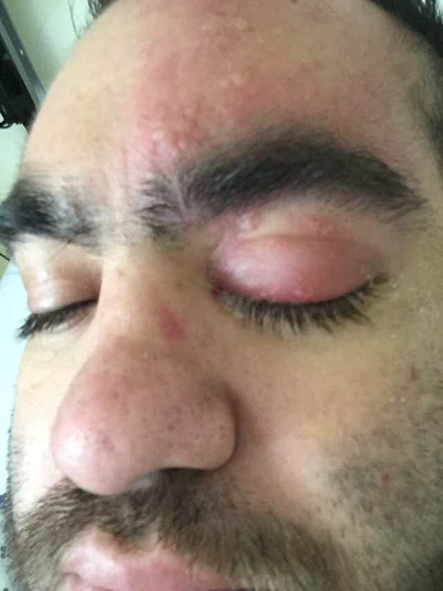 What S It Like To Have Eye Shingles Imagine Someone Has A Voodoo