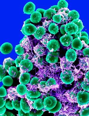 This 2011 digitally-colorized electron microscope image made available by the National Institute of Allergy and Infectious Diseases shows a clump of green-colored, spheroid-shaped, Staphylococcus epidermidis bacteria on a purple-colored matrix. We share our bodies with trillions of mostly friendly microbes that are important for things like good digestion. Now scientists are learning how that microbial zoo can change in ways that one day might let them predict who's at risk for brewing health problems.