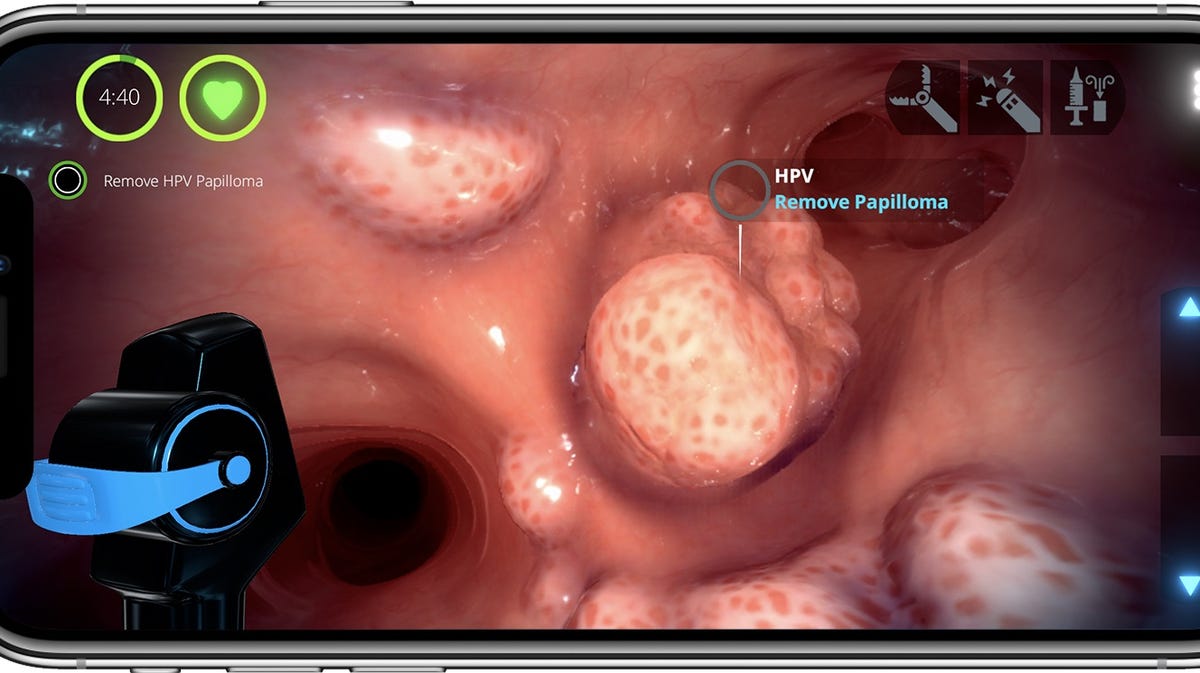 A player needs to remove a papilloma this case inside Level Ex's Pulm Ex game.
