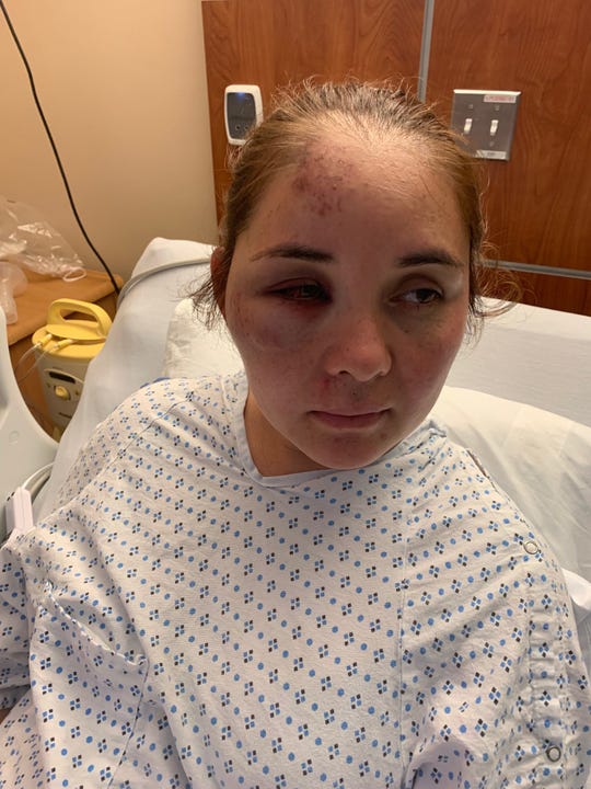Passaic's Beronica Ruiz in her hospital bed after she was attacked by her son's bully, her lawyer alleges. Her eye is blackened and the bruise on head is when she hit the pavement.