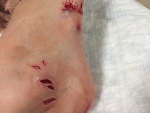 AJ Campione, 10, of Franklin was bitten likely by either a pike or muskie in Dodge County's Fox Lake on June 29 which required 16 stitches.