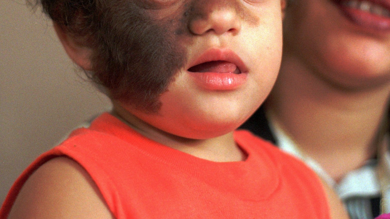 Werewolf syndrome' affects babies in after medication mix-up