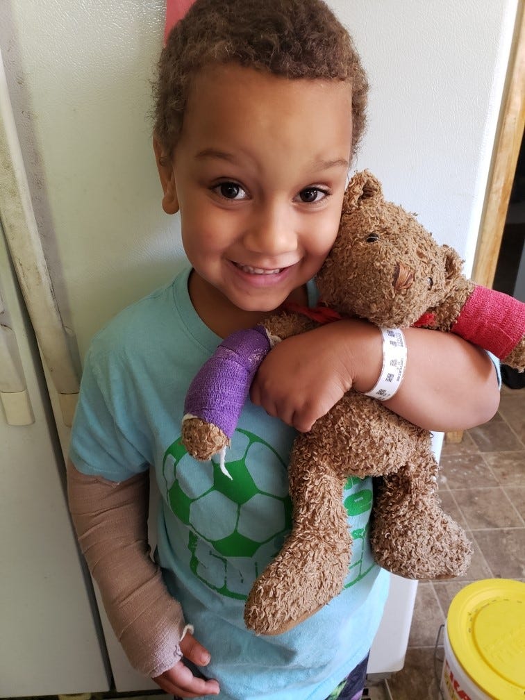 teddy bear with cast on arm