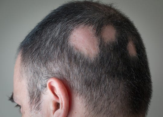 Losing Hair In Strange Places It Could Be Alopecia Areata