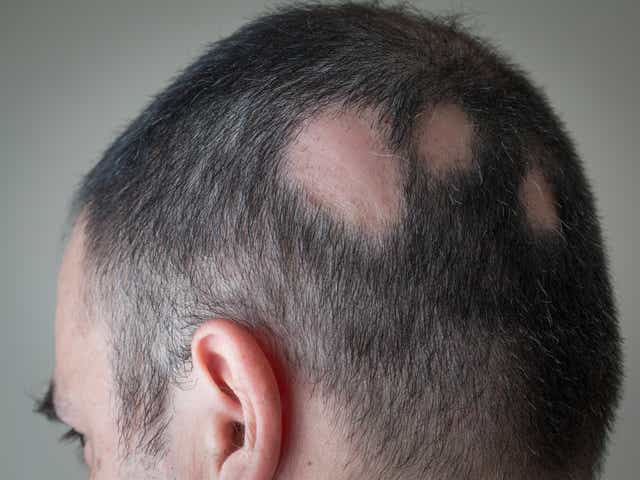 Losing Hair In Strange Places It Could Be Alopecia Areata