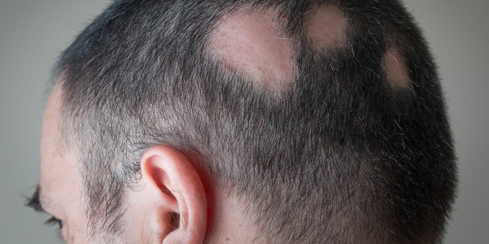 Losing Hair In Strange Places It Could Be Alopecia Areata