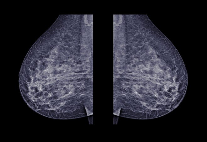 If You Have Dense Breast Tissue Talk To Your Physician About Additional Screening For Breast Cancer
